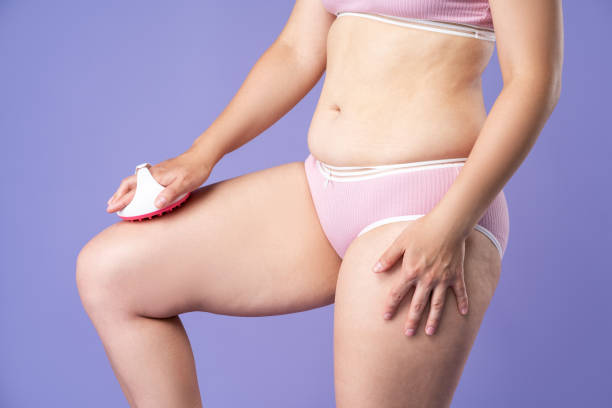 éliminer la cellulite